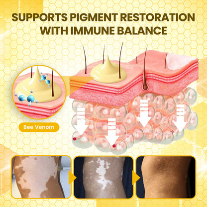Timilk® NaturaViti Bee Venom Vitiligo Cream