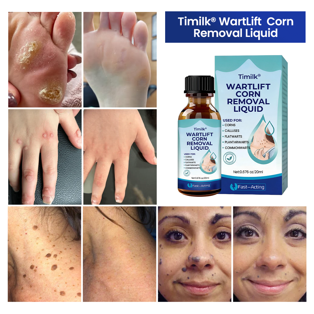 Timilk® WartLift Corn Removal Liquid (new)